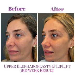 before-after photo lip-lift