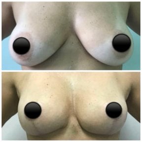 before-after photo breast-augmentation