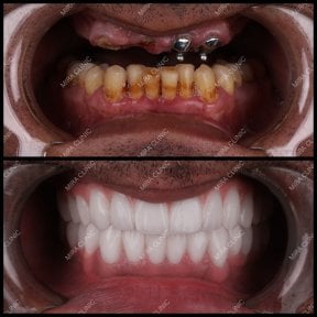 before-after photo dental-bridge-installation