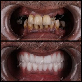 before-after photo all-on-6-dental-implants