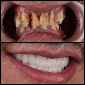 before-after photo all-on-6-dental-implants
