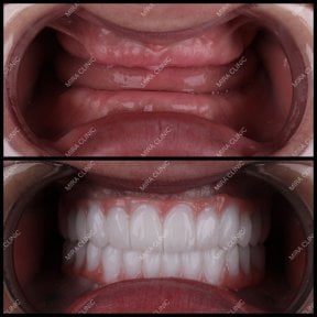 before-after photo all-on-6-dental-implants