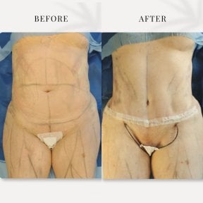 before-after photo abdominoplasty