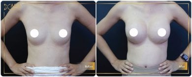 before-after photo breast-augmentation-with-fat-transfer