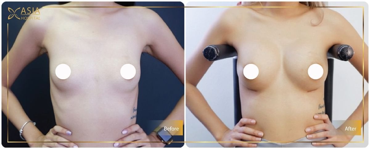 قبل وبعد تكبير الثدي بحقن الدهون في Asia Cosmetic Hospital، نتائج واضحة
