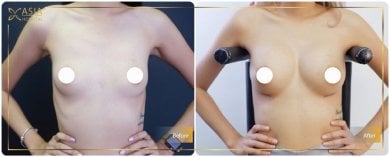 before-after photo breast-augmentation-with-fat-transfer
