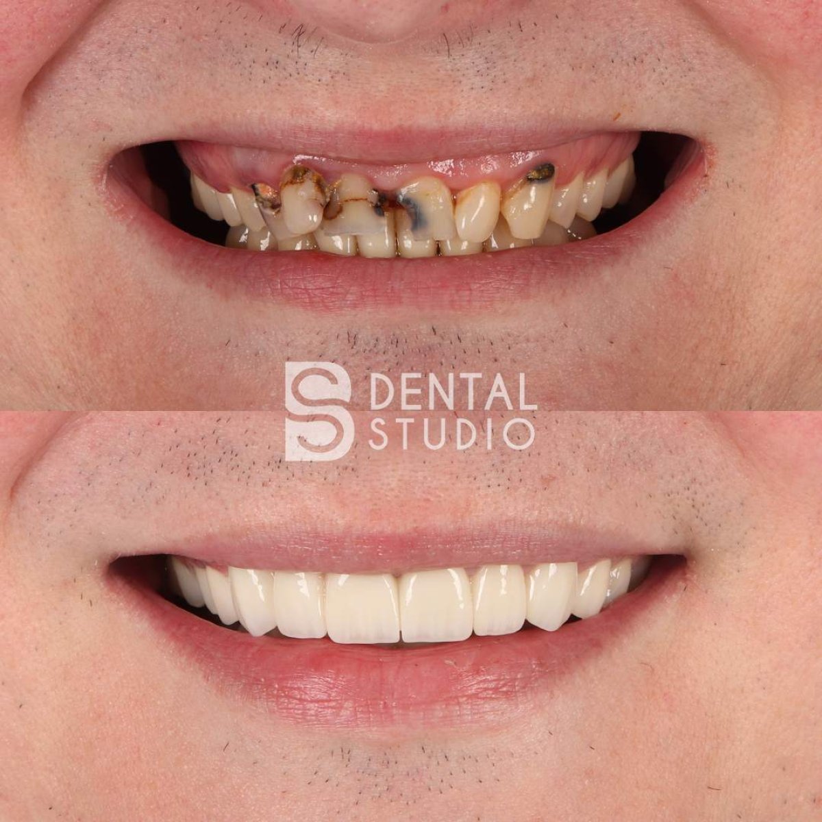 نتائج قبل وبعد تجميل الابتسامة في BS Dental Studio – استعادة كاملة للأسنان