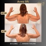 Résultats avant/après lifting des bras à ID Clinic Bangkok, contour et fermeté améliorés