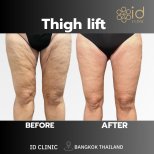Résultats avant/après lifting des cuisses à ID Clinic Bangkok, contour et fermeté améliorés