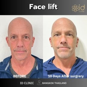 Résultats lifting visage avant/après à ID Clinic Bangkok, rajeunissement visible en 10 jours