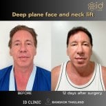 Résultats avant/après lifting profond du visage et du cou à ID Clinic Bangkok