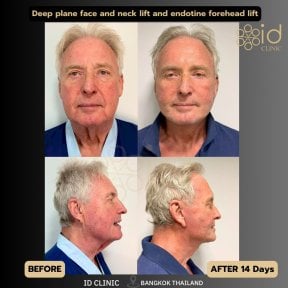 Résultats avant/après lifting profond visage et cou à ID Clinic Bangkok, 14 jours