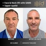 Résultats avant/après mini lifting visage et paupières supérieures à ID Clinic Bangkok