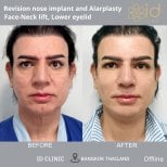 Résultats avant/après lifting visage-cou, rhinoplastie, alarplastie à ID Clinic Bangkok