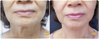نتائج شد الرقبة قبل وبعد في Asia Cosmetic Hospital – شد واضح للبشرة