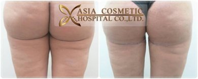 نتائج شد الفخذين قبل وبعد في Asia Cosmetic Hospital مع تحسين واضح لمحيط الفخذ