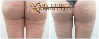 نتائج شد الفخذين قبل وبعد في Asia Cosmetic Hospital مع تحسين واضح لمحيط الفخذ