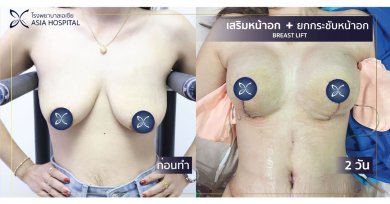نتائج قبل وبعد رفع وتكبير الثدي في Asia Cosmetic Hospital، تحسين شكل الصدر
