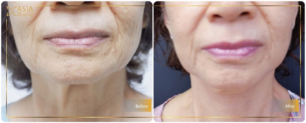 نتيجة شد الوجه العميق قبل وبعد في Asia Cosmetic Hospital، تجديد شباب الوجه