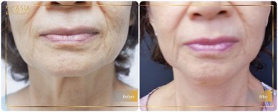 نتيجة شد الوجه العميق قبل وبعد في Asia Cosmetic Hospital، تجديد شباب الوجه