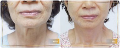 نتائج شد الوجه العميق قبل وبعد في Asia Cosmetic Hospital، تجديد شباب الوجه بوضوح
