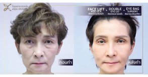 نتائج شد الوجه العميق قبل وبعد في Asia Cosmetic Hospital، تجديد شباب الوجه واضح