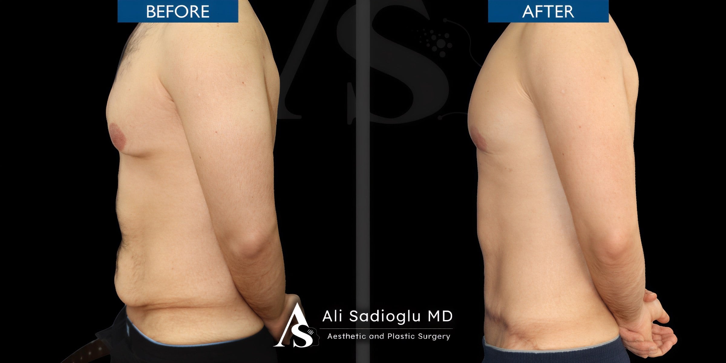 Resultados de abdominoplastia antes y después en Dr. Safa Manav Clinic, abdomen definido