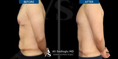 Before and after tummy tuck results at Dr. Safa Manav Clinic, visible abdominal contouring