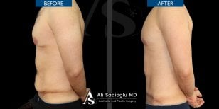Before and after tummy tuck results at Dr. Safa Manav Clinic, visible abdominal contouring