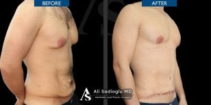Before and after tummy tuck results at Dr. Safa Manav Clinic, visible abdominal contouring