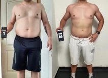 Before and after tummy tuck results at Dr. Safa Manav Clinic showing improved abdominal contour