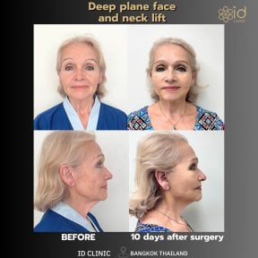 before-after photo breast-implant-revision