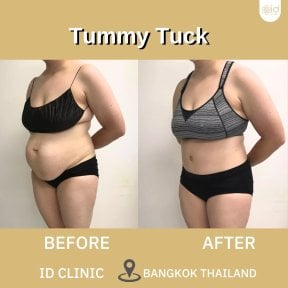 before-after photo tummy-tuck-and-liposuction