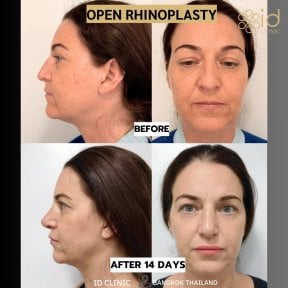 before-after photo rhinoplasty-nose-job