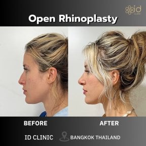 before-after photo rhinoplasty-nose-job