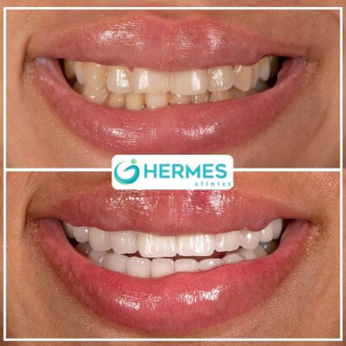 Antes y después de carillas dentales en Hermes Clinics: sonrisa más blanca y uniforme