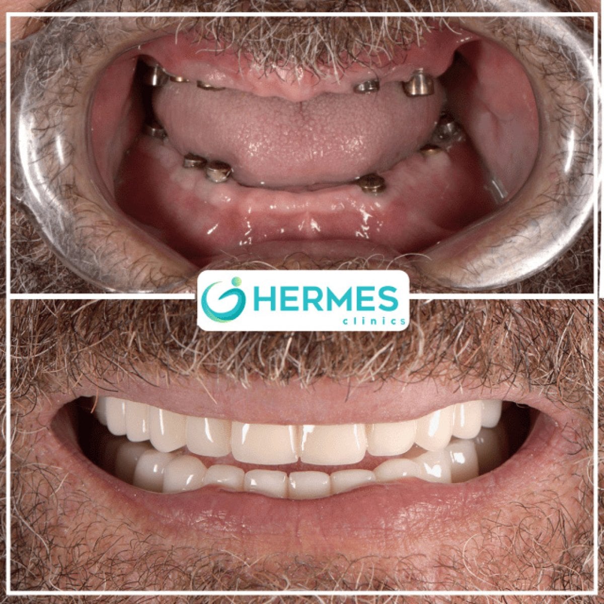 Resultados antes y después de implantes Flapless All-on-4 en Hermes Clinics, sonrisa restaurada