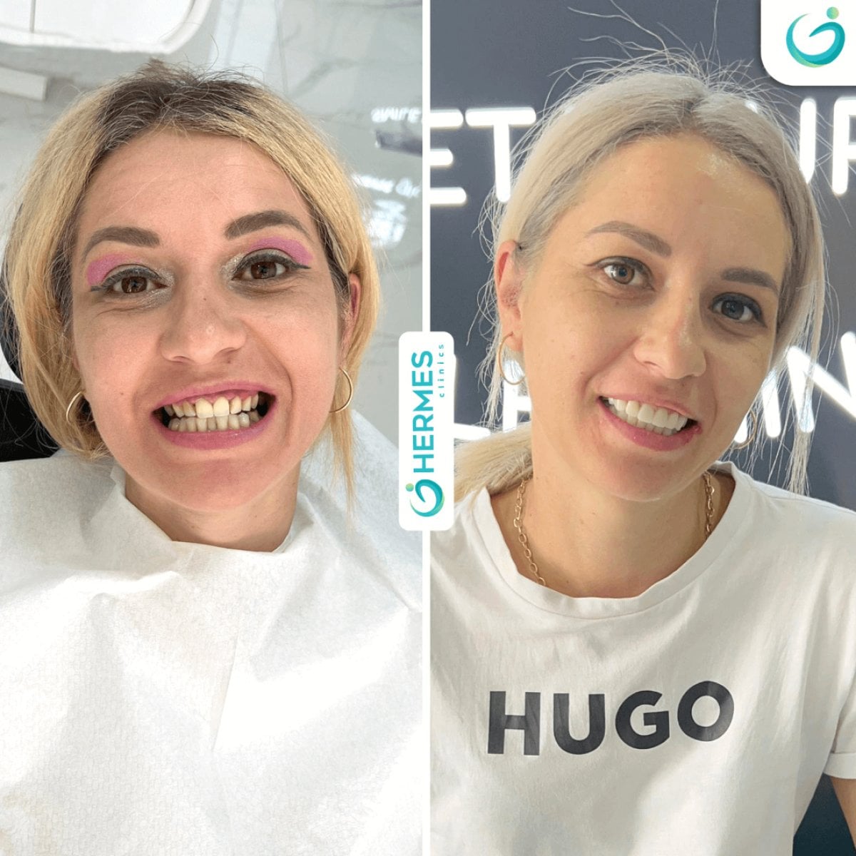 Resultados de blanqueamiento dental antes y después en Hermes Clinics – sonrisa más blanca
