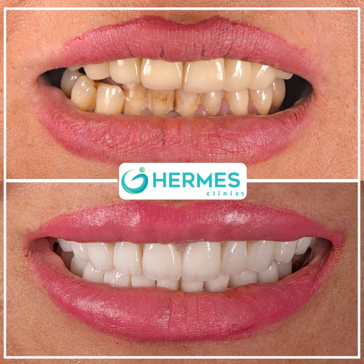 نتائج تبييض الأسنان قبل وبعد في Hermes Clinics – ابتسامة أكثر بياضاً وإشراقاً
