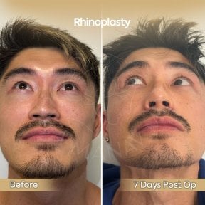 Before and after rhinoplasty results at Dr. Safa Manav Clinic, 7 days post-op nose reshaping