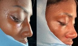 Before and after Fox Eye Lift results at Dr. Safa Manav Clinic, enhanced eye contour visible