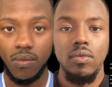 Fox Eye Lift before and after results at Dr. Safa Manav Clinic, enhanced eye contour visible