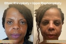 Before and after ethnic rhinoplasty and upper blepharoplasty results at Dr. Safa Manav Clinic