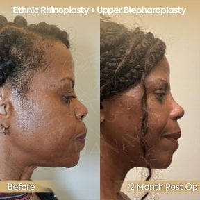 Before and after ethnic rhinoplasty and upper blepharoplasty at Dr. Safa Manav Clinic results