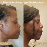 Before and after ethnic rhinoplasty and upper blepharoplasty at Dr. Safa Manav Clinic results
