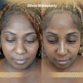 Before and after ethnic rhinoplasty results at Dr. Safa Manav Clinic, 7 days post-op
