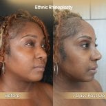Before and after ethnic rhinoplasty results at Dr. Safa Manav Clinic, nose reshaping outcome