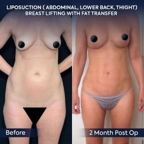 before-after photo liposuction