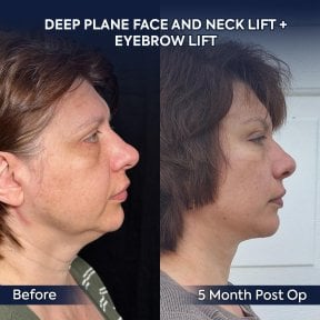 before-after photo deep-plane-facelift