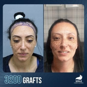 before-after photo hair-transplant